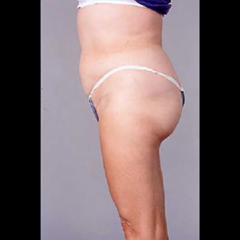 How Can I Remove Fat from My Flanks?, Liposuction Newport Beach