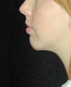 Chin Surgery Patient 82126