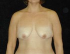 Breast Lift Patient 17890