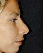 Nose Surgery Patient 99917