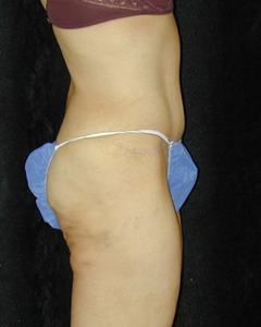 Tummy Tuck Patient 90796 After Photo # 2
