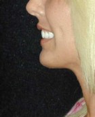Chin Surgery Patient 62940