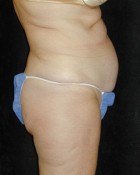 Tummy Tuck Patient 23720 Before Photo Thumbnail # 1
