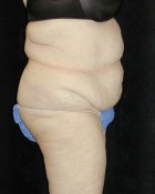 Tummy Tuck Patient 43836