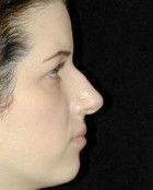 Nose Surgery Patient 91635