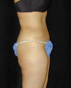 Tummy Tuck Patient 68559 After Photo # 2