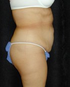 Tummy Tuck Patient 24053