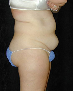 Tummy Tuck Patient 31858 Before Photo # 1