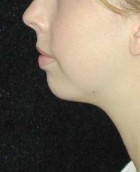 Chin Surgery Patient 82126