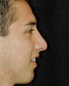 Nose Surgery Patient 54546