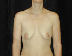 Breast Lift Patient 80949 Before Photo # 1