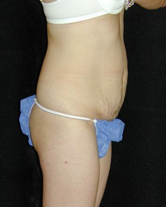 Tummy Tuck Patient 56305 Before Photo # 1