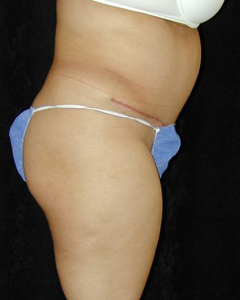 Tummy Tuck Patient 33309 After Photo # 2