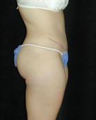 Tummy Tuck Patient 29067 After Photo Thumbnail # 2