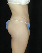 Tummy Tuck Patient 29067 After Photo Thumbnail # 2