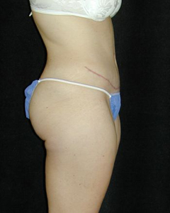 Tummy Tuck Patient 29067 After Photo # 2