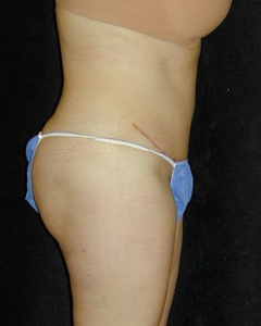 Tummy Tuck Patient 18448 After Photo # 2