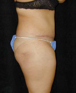 Tummy Tuck Patient 72040 After Photo # 2