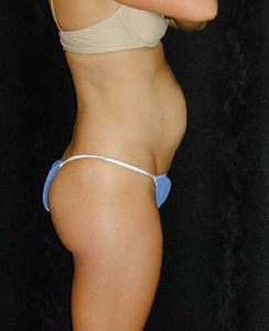 Tummy Tuck Patient 84598 Before Photo # 1