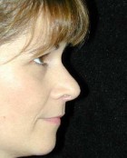 Nose Surgery Patient 63726