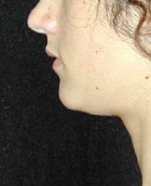Chin Surgery Patient 92696 Before Photo Thumbnail # 1