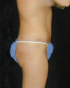 Tummy Tuck Patient 50625 After Photo # 2