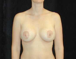 Breast Lift Patient 80949 After Photo # 2