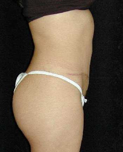 Tummy Tuck Patient 92595 After Photo # 2