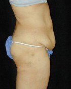 Tummy Tuck Patient 90796