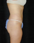 Tummy Tuck Patient 57893 After Photo Thumbnail # 2