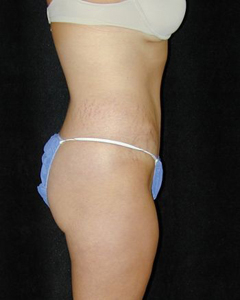 Tummy Tuck Patient 57893 After Photo # 2