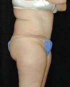 Tummy Tuck Patient 31858