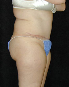 Tummy Tuck Patient 31858 After Photo # 2