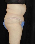 Tummy Tuck Patient 43836