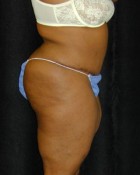Tummy Tuck Patient 11652