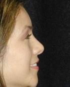 Nose Surgery Patient 77603