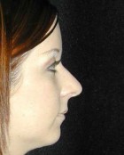 Nose Surgery Patient 15621