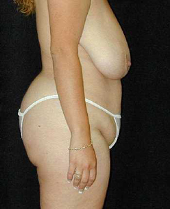 Tummy Tuck Patient 14766 Before Photo # 1