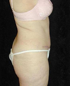Tummy Tuck Patient 30127 After Photo # 2