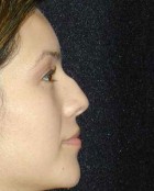Nose Surgery Patient 77603