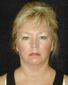 Patient # 63504 Before Photo # 5