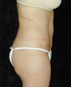 Tummy Tuck Patient 38518 After Photo # 2