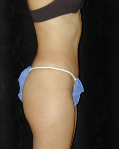 Tummy Tuck Patient 22297 After Photo # 2