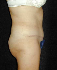 Tummy Tuck Patient 18049 After Photo # 2