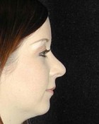 Nose Surgery Patient 15621