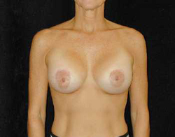 Breast Lift Patient 92077 After Photo # 2