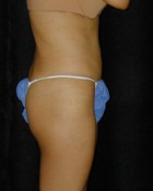 Tummy Tuck Patient 11716