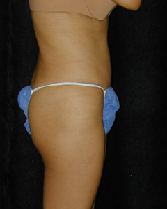 Tummy Tuck Patient 11716 After Photo # 2
