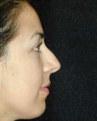 Nose Surgery Patient 53618