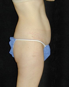 Tummy Tuck Patient 52769 Before Photo # 1